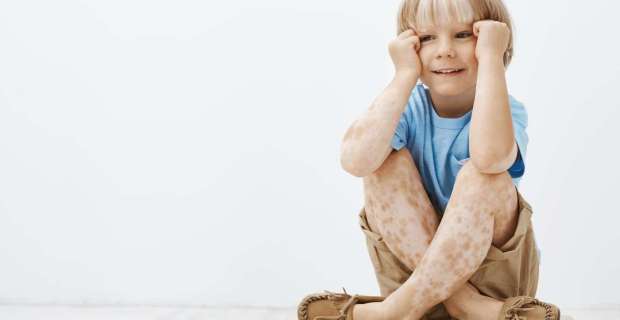 Bolest ruku, nogu i usta (BRNU): Vodič za roditelje