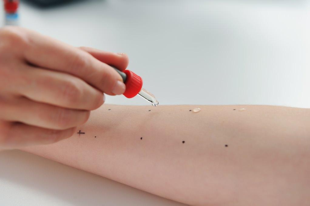 Prick kožne probe panel inhalacioni alergeni